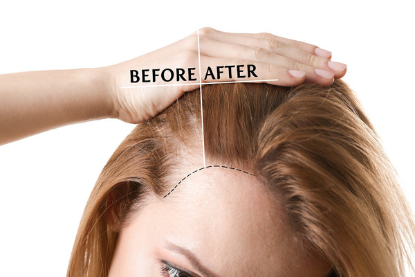 A Guide to Hair Transplant in Korea