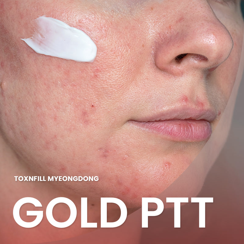 Gold PTT: Acne treatment  in Myeongdong, Toxnfill