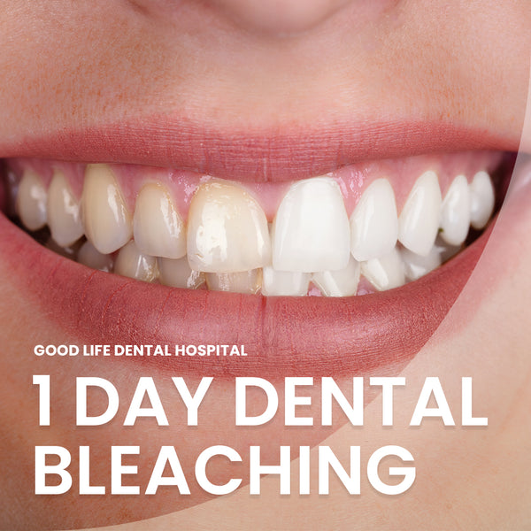 1 DAY Dental Bleaching
