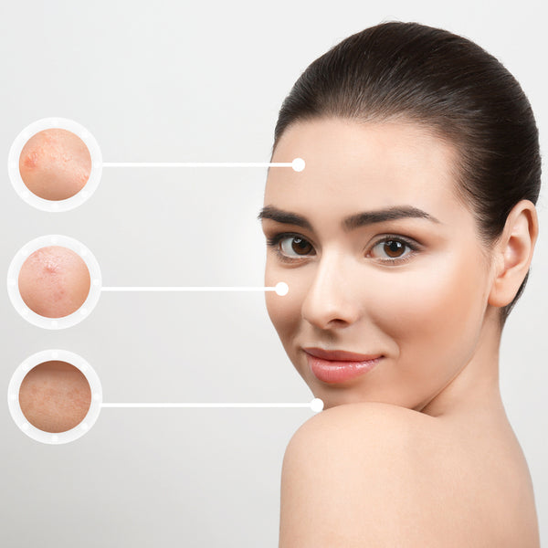 One-day acne scar treatment package [Chang Dermatology Clinic] - Treatment